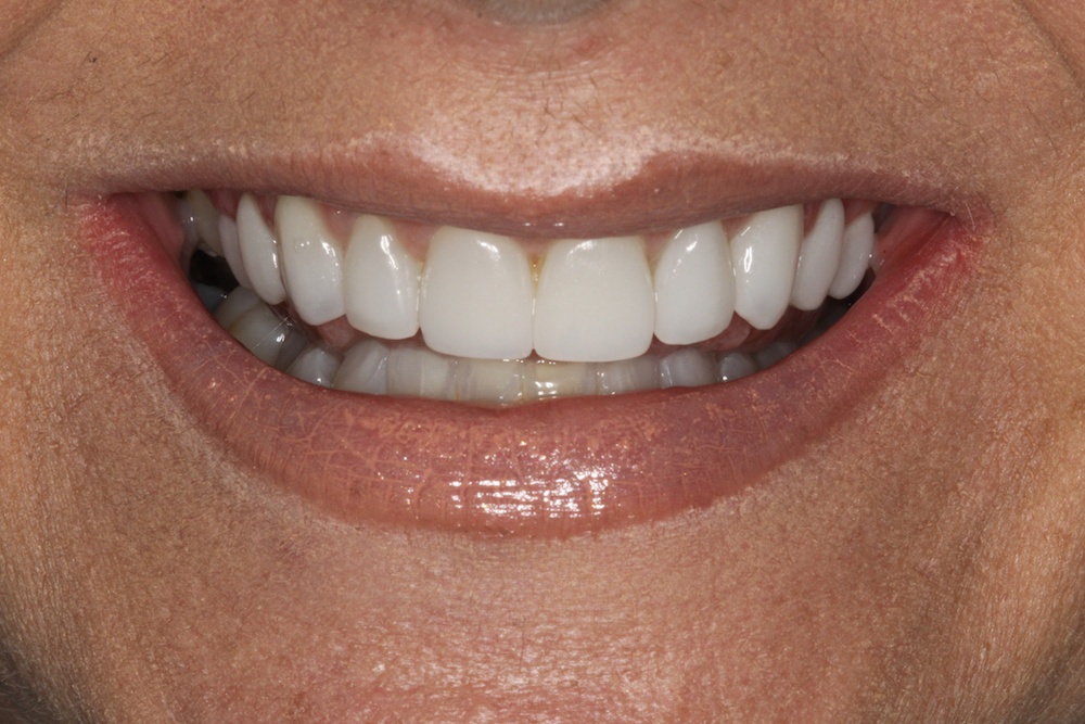 Experience the Elite Dental Approach to Personalized Veneers New