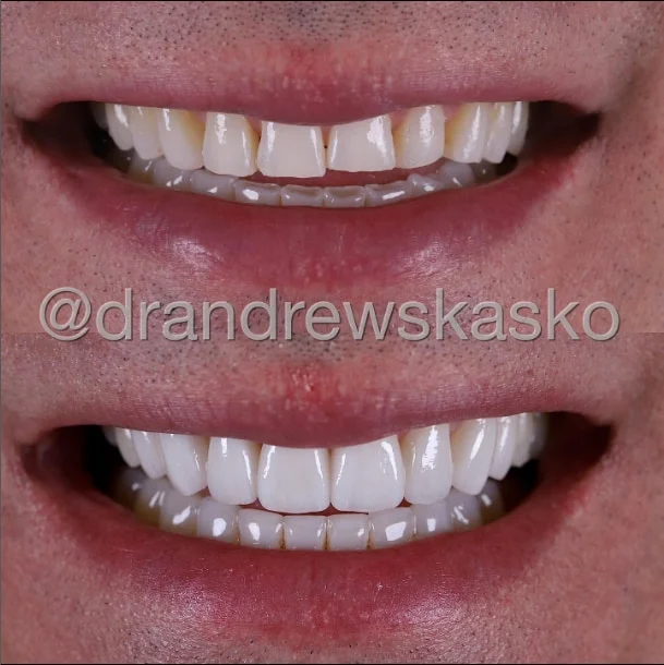 Is It Possible to Fix My Asymmetrical Smile?